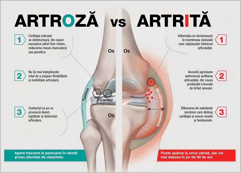 Cum să tratezi artroza