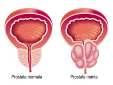Mărirea prostatei - ce trebuie să știi
