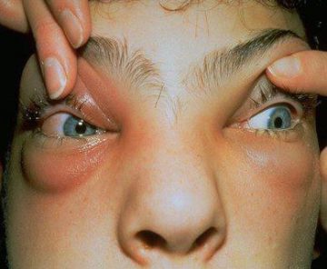 alergie ochi umflati tratament naturist licopen și vedere
