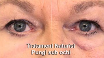 tratament natural anti-îmbătrânire pentru ochi