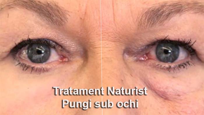 tratament naturist pentru pungile de sub ochi