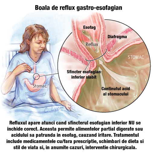 Reflux esofagian