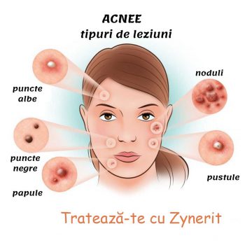 prescriptie pentru acnee anti-imbatranire