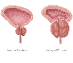 Caiuri prostata