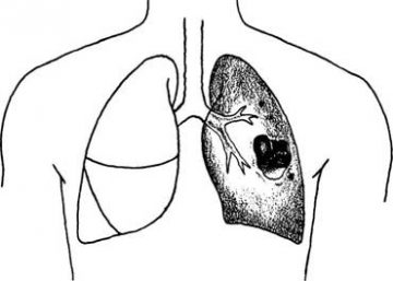 abces pulmonar tratat naturist