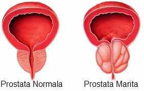 gură uscată cu prostatită microclistere pentru prostatită și adenom de prostată