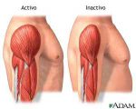 atrofia musculara