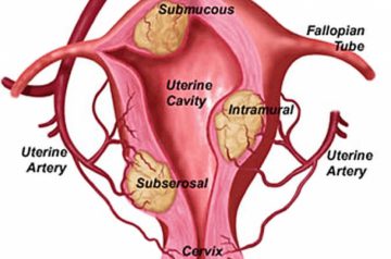 fibrom uterin tratament